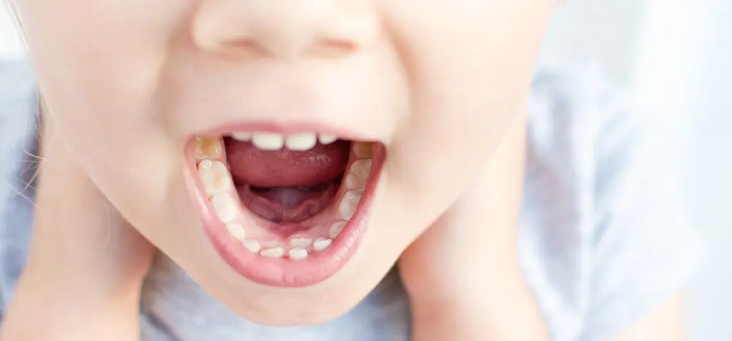 Shark Teeth in Kids: Steps to Keep Their Smile on Track