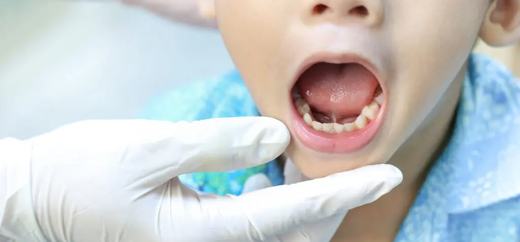 Understanding Tongue Tie and Its Impact On Speech