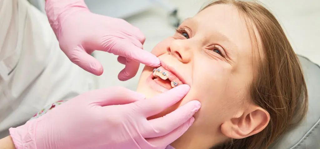 Can Braces Fix an Underbite? A Guide to Treatment Options