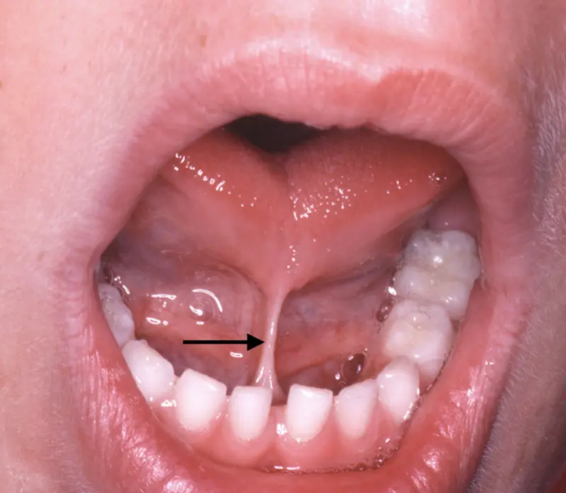 Tongue Tie Ankyloglossia