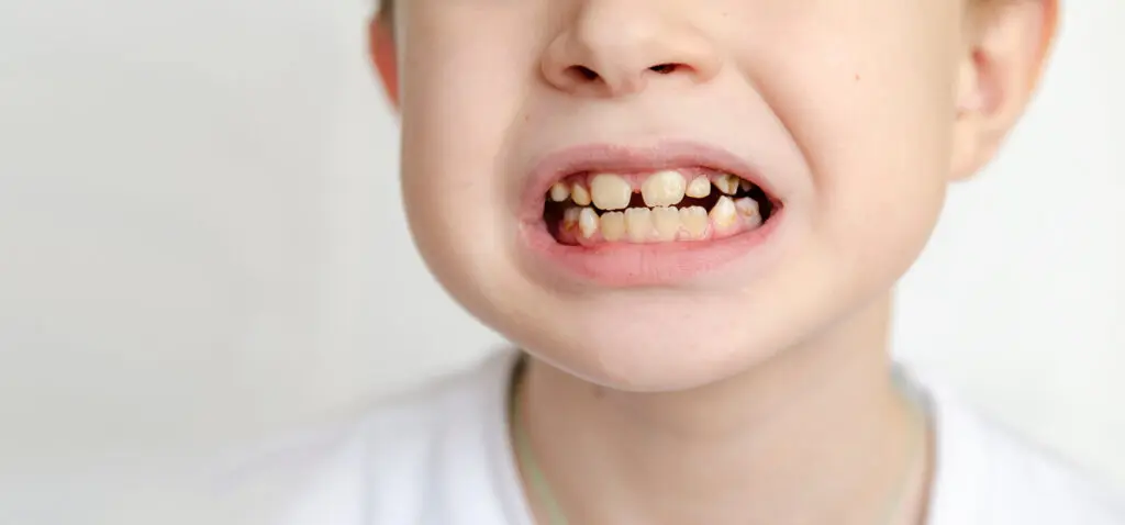 Hypoplastic Enamel in Children: What Parents Should Know
