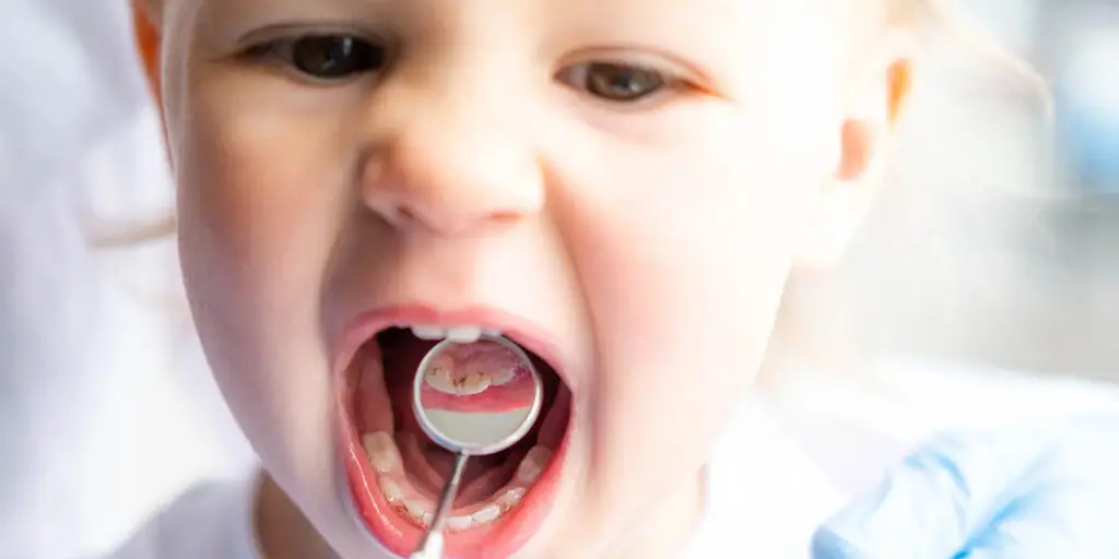 Toddler Tooth Decay: A Parent’s Guide to Prevention, Reversal, and Treatment