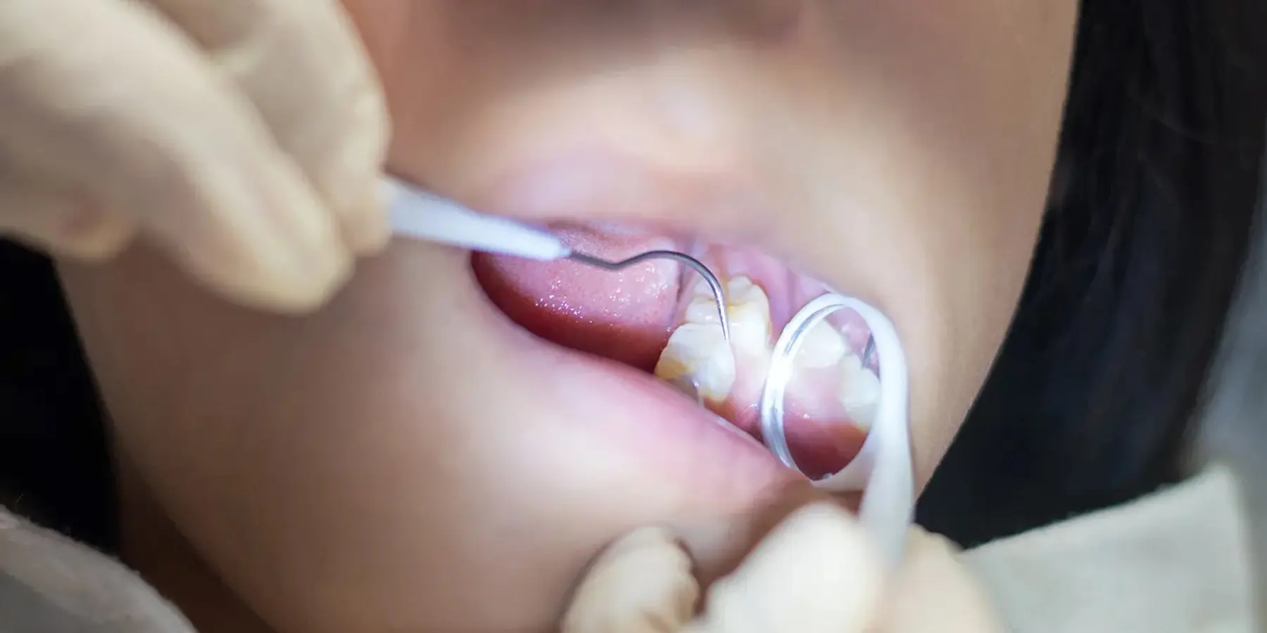 Pediatric Dental Crowns: When and Why Kids Need Them