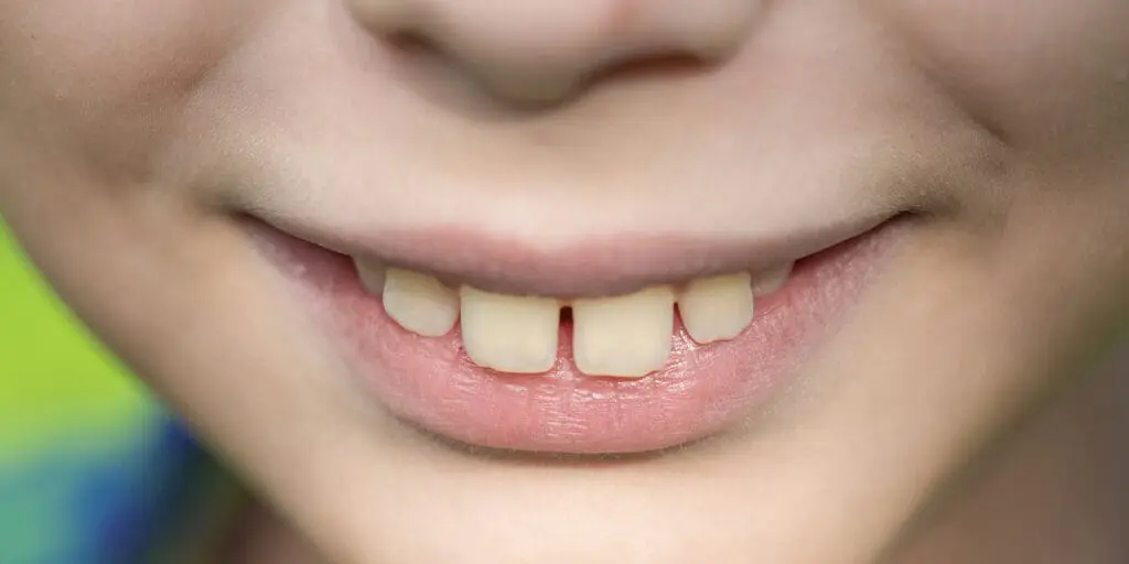 Normal Bite vs Overbite: How to Tell The Difference