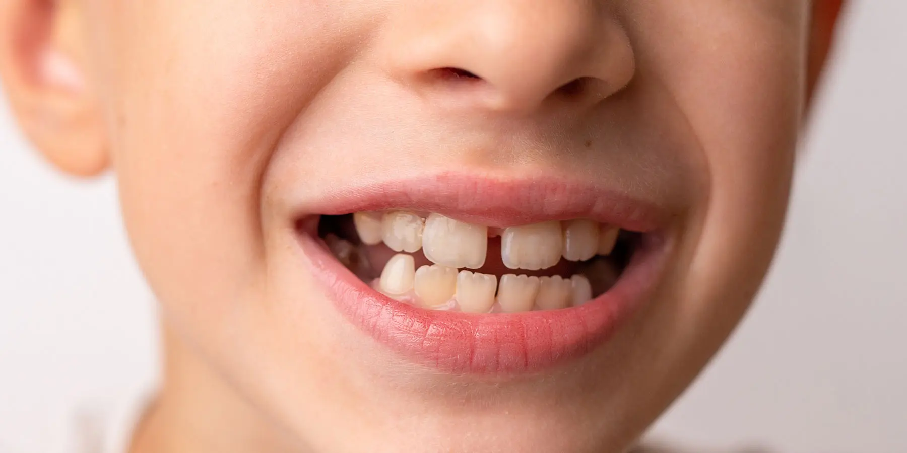 Will the Gap Between My Child’s Front Teeth Close?