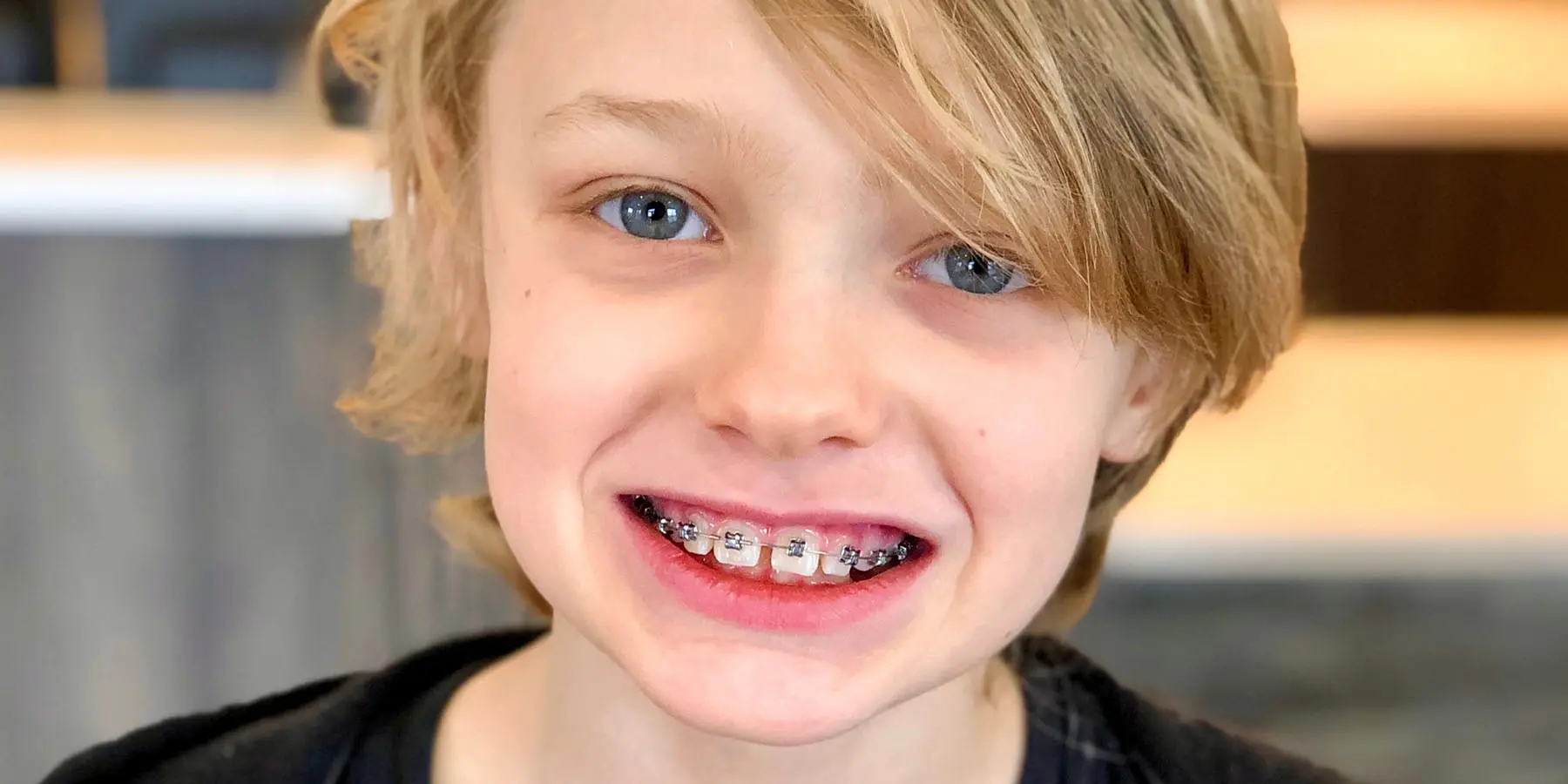Can Kids Wear a Mouthguard With Braces?