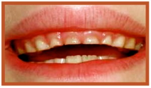 Bruxism, Nighttime Teeth-Grinding