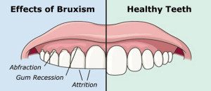 teeth grinding