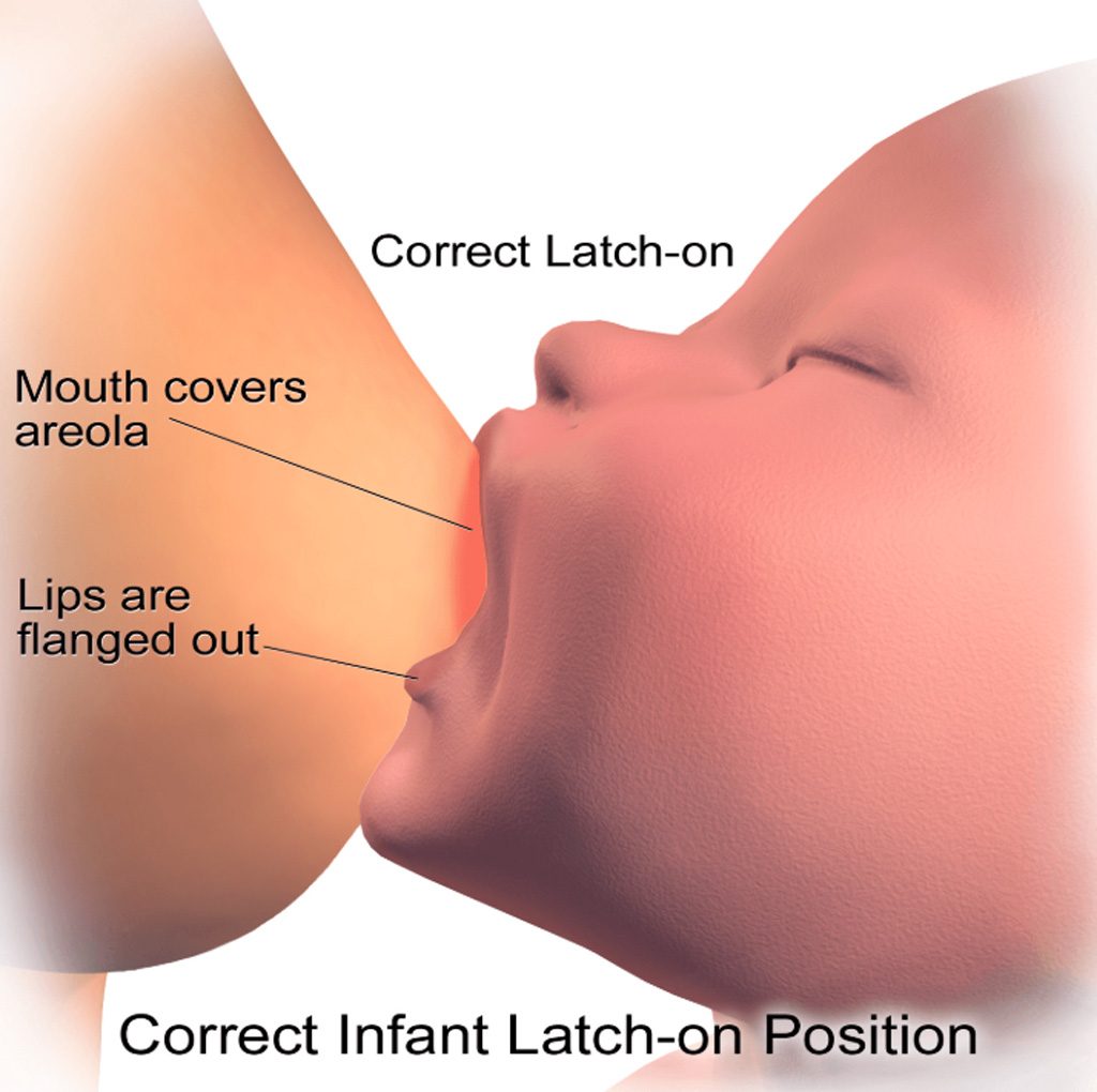 Painful breastfeeding, What is a Frenectomy?