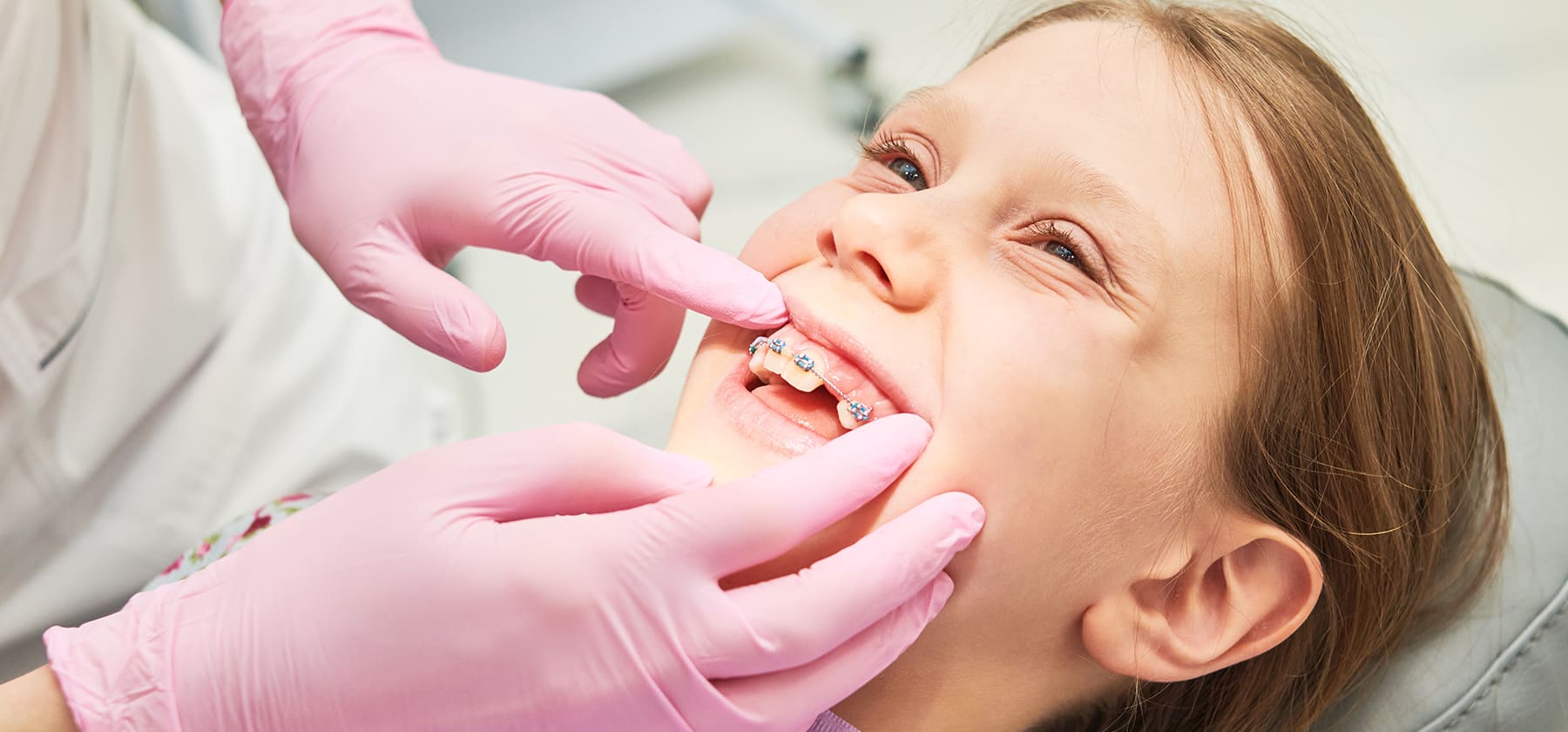 Can Braces Fix an Underbite? A Guide to Treatment Options